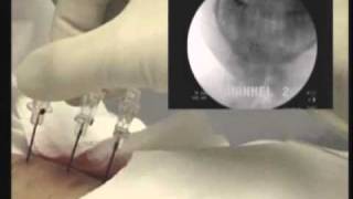 Cervical Spine Radiofrequency Ablation [upl. by Ellerrehs135]