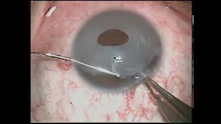 Eye Color Change New iris Implant removal exhanged to Brightocular [upl. by Loriner]