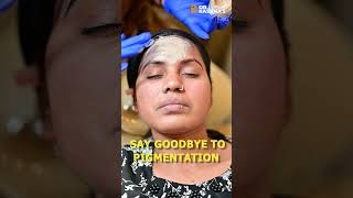 COSMELAN PEEL TREATMENT AT DRKASANAS CLINIC [upl. by Autry]