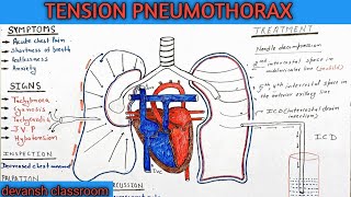 tension pneumothorax in Hindi [upl. by Geehan]