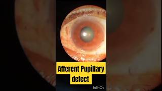 Afferent Pupillary Defect  APD pupilteacher eyediseases [upl. by Ariayek399]