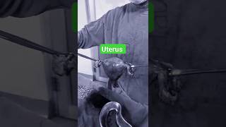 uterus fibroiduterus uterustransplant retroverteduterus shortsfeed shortvideo [upl. by Enifesoj]