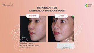 DERMALAX IMPLANT PLUS AREA TREATMENT NOSE AND CHIN [upl. by Selma881]