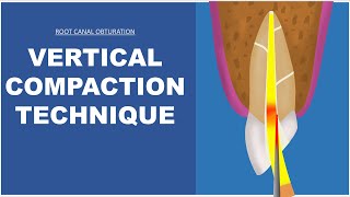 Vertical Compaction Technique  Root Canal Obturation [upl. by Auric]