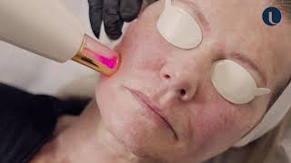 Resurfx fractional nonablative skin resurfacing at Quinn Clinics Bristol [upl. by Hasila37]