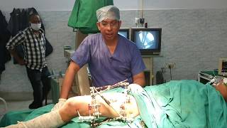 Limb lengthening amp Deformity Correction at Patna  Dr Shamsul Hoda Ilizarov Cases  in Hindi [upl. by Zipah]