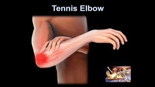 Tennis Elbow why it hurts Everything You Need To Know  Dr Nabil Ebraheim [upl. by Doreen839]