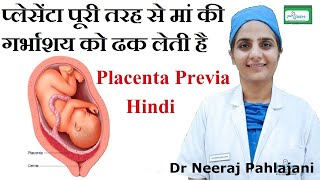 Placenta Previa होने के लक्षण इलाज और Low Lying Placenta से कैसे बचे [upl. by Hesper]