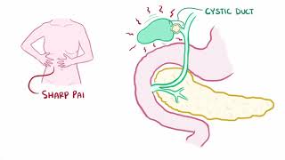 Biliary colic gallbladder attack causes symptoms diagnosis treatment amp pathology [upl. by Ainekahs]