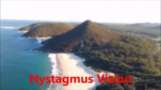 Whats your vision like with nystagmus [upl. by Ellard265]