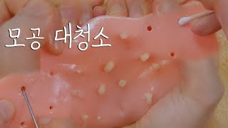 피지 짜고 귀이개로 모공 속 마무리｜여드름 장난감｜ASMR [upl. by Vanna941]