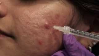 Watch amp Learn Intralesional injections [upl. by Ayokahs]