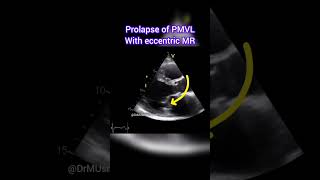 Prolapse of Posterior Mitral Valve Leaflet with Eccentric MR echocardiogram echocardiography [upl. by Hemminger]