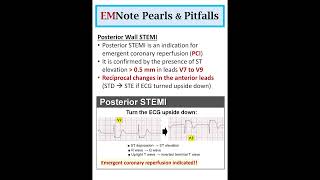 Posterior Wall STEMI doctor medical nursing [upl. by Ymeon]