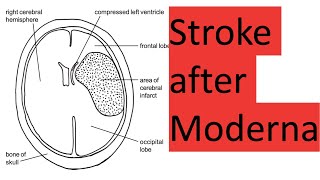 Stroke and death after Moderna [upl. by Laehcim358]