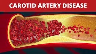 Treatment of Carotid Artery Disease [upl. by Aneert17]