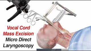 Vocal Cord Surgery Mass Excision  Micro Direct Laryngoscopy [upl. by Catlin]