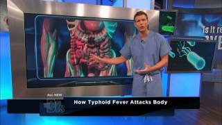 How Typhoid Fever Affects the Body  The Doctors [upl. by Ennairac317]