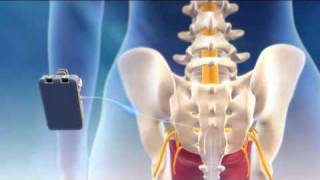 Overview of Sacral Nerve Stimulation for Urinary Control [upl. by Thapa651]