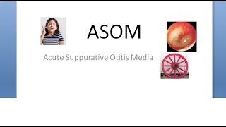 ENT ASOM Acute Suppurative Otitis Media Necrotizing Cart wheel appearance middle ear infection [upl. by Michail467]