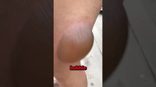 Weird Bubble On My Skin 😱🫧 [upl. by Okuy]