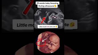 25 weeks baby sneezing during ultrasound😘😘viralvideo trending viralshorts [upl. by Ibbed]