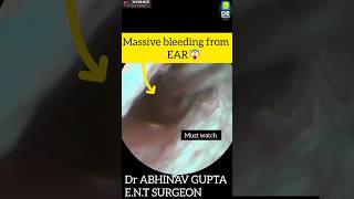 EAR BLEEDING AND BLOOD THINNEROPD shorts by Dr ABHINAV [upl. by Noremmac]