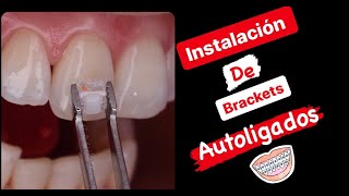 Instalación de Brackets Autoligados Estéticos 💎 [upl. by Mayce]