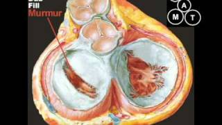 Animated Mitral Stenosis Murmur [upl. by Herries]