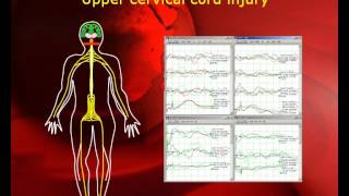 quotPatient Transparentquot Intraoperative Neurophysiological Monitoring in MISS [upl. by Fen]