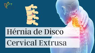 Hérnia de Disco Cervical Extrusa [upl. by Ymij]