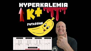 Why Hyperkalemia causes a widened QRS complex on the ECG  Explained [upl. by Ferriter]