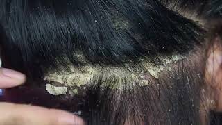 Dandruff scratching removal on head using black combing405 [upl. by Olvan208]