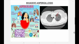 Invasive Aspergillosis [upl. by Chapnick]