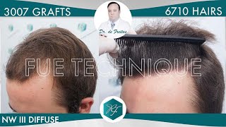 Hair Graft Technique FUE Grafts 3007 6710 Hairs [upl. by Craggie]