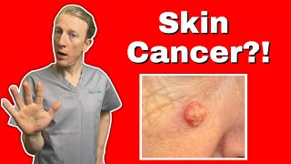 Squamous Cell Skin Cancer SCC  What You Need to Know for Early Detection and Treatment [upl. by Ajssatsan264]