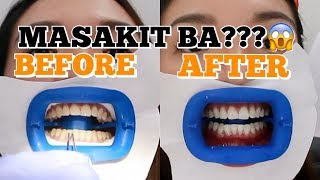 FIRST TEETH WHITENING EXPERIENCE SHOCKING RESULTS  Angel Dei [upl. by Ailec]