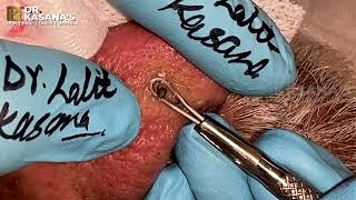 70 YEAR OLD NOSE BLACKHEADS REMOVAL AT DRKASANAS CLINIC [upl. by Enal796]