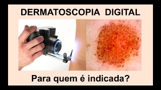 DERMATOSCOPIA DIGITAL  O que é este exame Para quem está indicado [upl. by Ingmar]