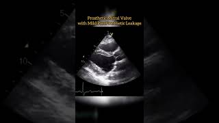 Prosthetic Mitral Valve echocardiogram echo Echocardiography For Beginners [upl. by Heyde]