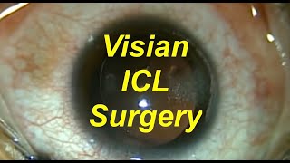 Visian ICL implantable contact lens and bioptics 51611 Shannon Wong MD [upl. by Oirotciv]