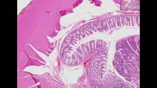 Histopathology Colon Adenocarcinoma [upl. by Suirauqed949]