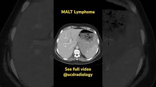 MALT lymphoma cancer lymphoma medicine radiology medicalstudent doctor [upl. by Adikram414]