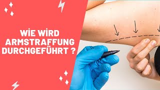 Wie Wird Armstraffung Durchgeführt [upl. by Ariaec]