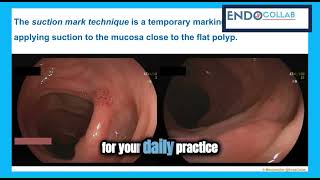 Enhancing Colonoscopy Practice Utilizing the Suction Technique [upl. by Akcirederf]