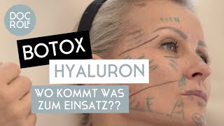 BOTOX oder HYALURON – wann verwendet man was Dr Rolf Bartsch [upl. by Salvatore]