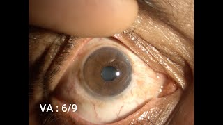 Therapeutic Keratoplasty Step by Step [upl. by Belden]