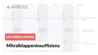 Mitralklappeninsuffizienz  Herzgeräusch  AMBOSS Video [upl. by Aksoyn]