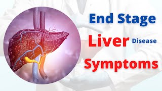 Symptoms of End Stage Liver Disease  Liver Cirrhosis [upl. by Goto]