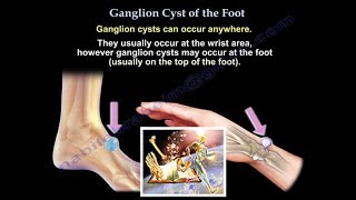 Ganglion Cyst Of The Foot  Everything You Need To Know  Dr Nabil Ebraheim [upl. by Rehtnug500]